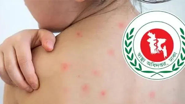 দেশে হাম ও উপসর্গে মৃত্যু ১২০০ ছাড়াল, একদিনে মৃত ৫