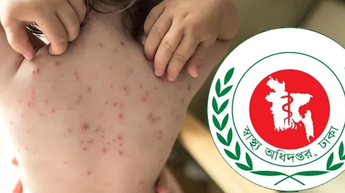 হাসপাতালে হামের চিকিৎসাধীন রোগী ও স্বাস্থ্যসেবা।